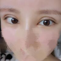 開內(nèi)眼角割雙眼皮恢復(fù)全過程和圖片分享