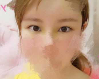 開內(nèi)眼角割雙眼皮恢復(fù)全過程和圖片分享，雙眼皮多項(xiàng)整形整形