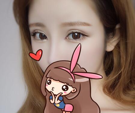 開內(nèi)眼角割雙眼皮恢復(fù)全過程和圖片分享，雙眼皮多項(xiàng)整形整形