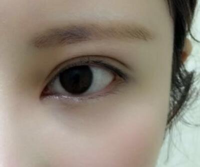 開內(nèi)眼角割雙眼皮恢復(fù)全過程和圖片分享，雙眼皮多項(xiàng)整形整形