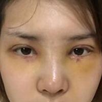 做了割雙眼皮和開內(nèi)眼角雙眼皮多項(xiàng)整形整形手術(shù)，恢復(fù)圖片日志分享