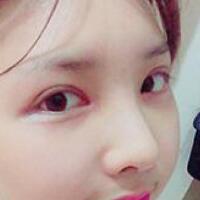 做了割雙眼皮和開內(nèi)眼角雙眼皮多項(xiàng)整形整形手術(shù)，恢復(fù)圖片日志分享