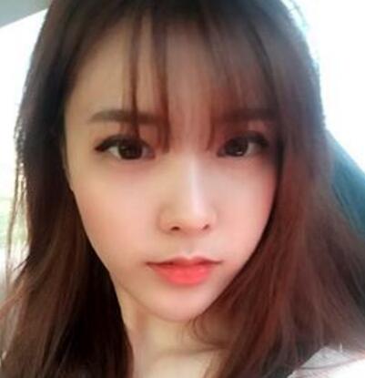 做了割雙眼皮和開內(nèi)眼角雙眼皮多項整形整形手術(shù)，恢復圖片日志分享