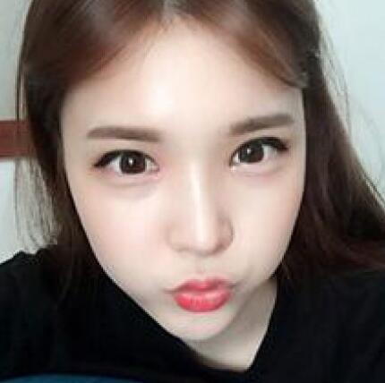 做了割雙眼皮和開內(nèi)眼角雙眼皮多項整形整形手術(shù)，恢復圖片日志分享