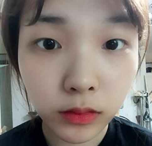 做了割雙眼皮和開內(nèi)眼角雙眼皮多項整形整形手術(shù)，恢復圖片日志分享