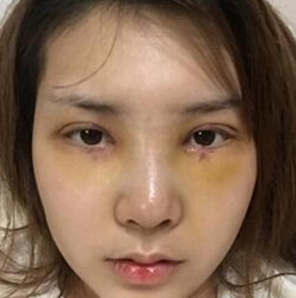 做了割雙眼皮和開內(nèi)眼角雙眼皮多項整形整形手術(shù)，恢復圖片日志分享