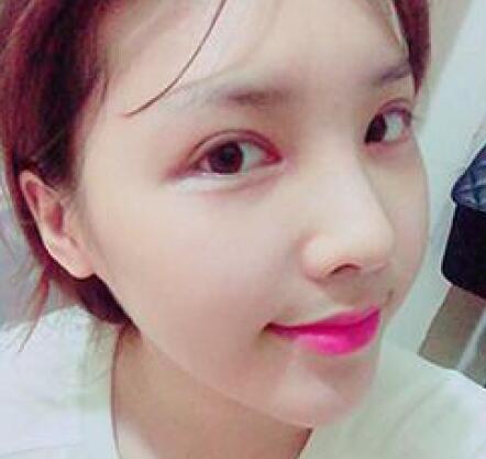 做了割雙眼皮和開內(nèi)眼角雙眼皮多項整形整形手術(shù)，恢復圖片日志分享