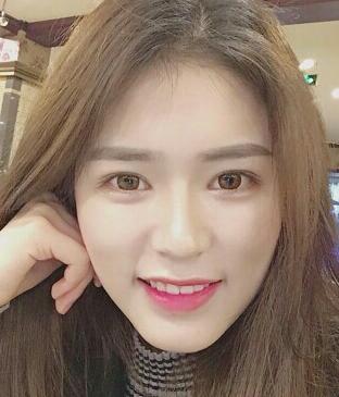 廣州凱美達(dá)皮膚美容激光祛斑前后對比