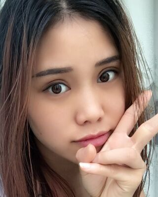 雙眼皮失敗修復(fù)果圖，福州愛美爾王召克做的