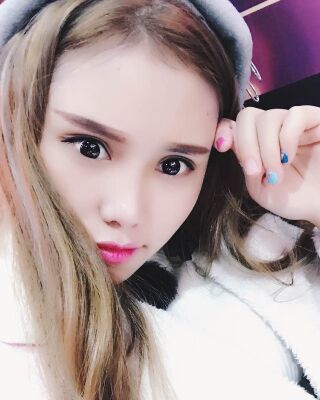 雙眼皮失敗修復(fù)果圖，福州愛美爾王召克做的