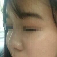 在濟(jì)南吉芙醫(yī)院做的玻尿酸填充淚溝，填充淚溝圖片分享