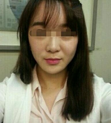 在濟(jì)南吉芙醫(yī)院做的玻尿酸填充淚溝，填充淚溝圖片分享