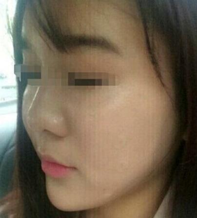 在濟(jì)南吉芙醫(yī)院做的玻尿酸填充淚溝，填充淚溝圖片分享