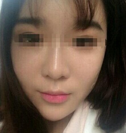 在濟(jì)南吉芙醫(yī)院做的玻尿酸填充淚溝，填充淚溝圖片分享