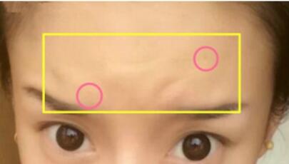 注射瘦臉去抬頭紋果不錯(cuò)——濟(jì)南吉芙美容整形醫(yī)院