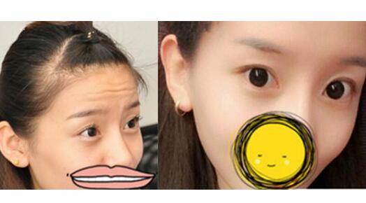 注射瘦臉去抬頭紋果不錯(cuò)——濟(jì)南吉芙美容整形醫(yī)院