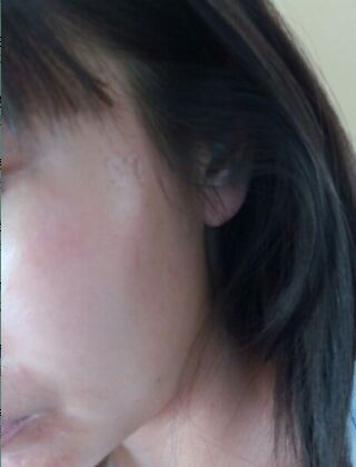 激光去咖啡斑恢復(fù)過程，福州美貝爾真實案例