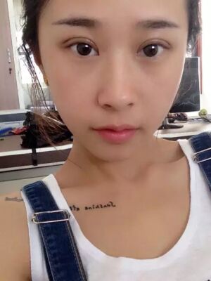 福州美貝爾切開雙眼皮成功案例前后對比圖