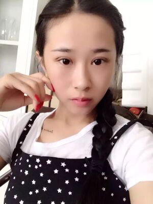 福州美貝爾切開雙眼皮成功案例前后對比圖