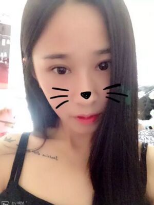 福州美貝爾切開雙眼皮成功案例前后對比圖