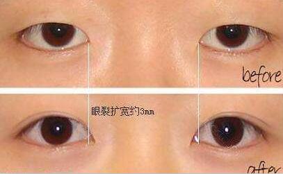 開眼角+割雙眼皮，眼睛整形價(jià)格表曝光
