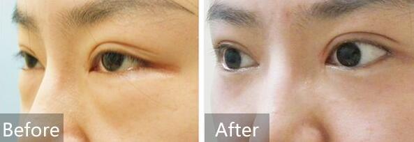 去眼袋前后對(duì)比圖，去眼袋價(jià)格