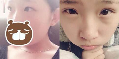 割雙眼皮前后對(duì)比圖，眼睛整形價(jià)格