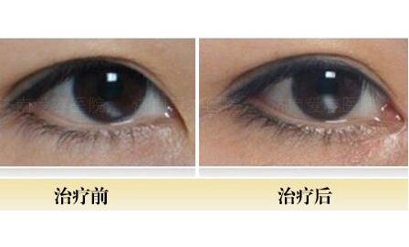 開內(nèi)眼角前后對(duì)比圖，眼睛整形價(jià)格