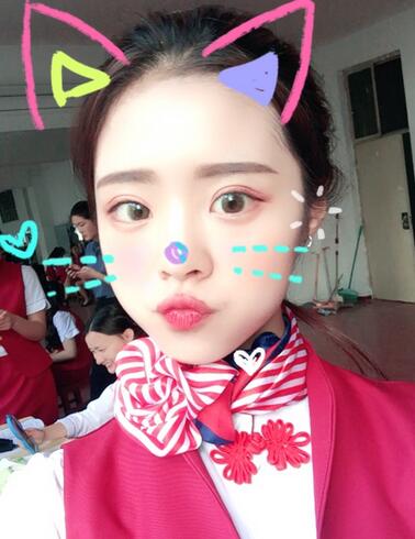 上海澳雅鄺勇韓式全切雙眼皮恢復(fù)過程圖