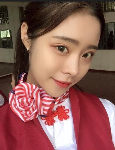 上海澳雅鄺勇韓式全切雙眼皮恢復(fù)過程圖