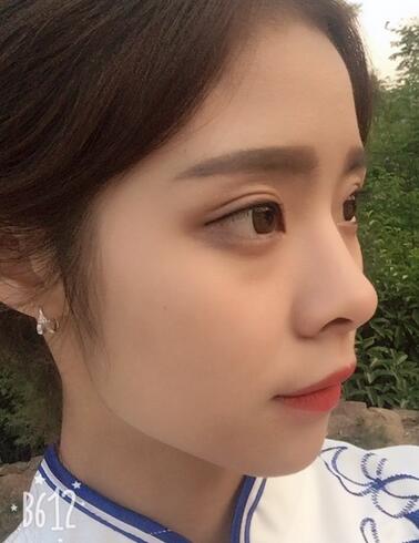 上海澳雅鄺勇韓式全切雙眼皮恢復(fù)過程圖