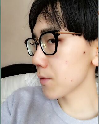 男生隆鼻整形案例分享，福州美貝爾張潮做的