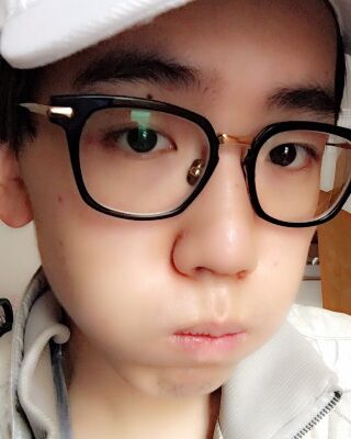 男生隆鼻整形案例分享，福州美貝爾張潮做的