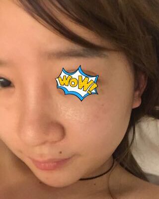 第(一)次激光去雀斑果圖，貴陽美萊劉紅武做的