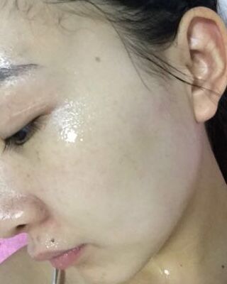 第(一)次激光去雀斑果圖，貴陽美萊劉紅武做的