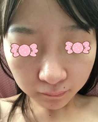 第(一)次激光去雀斑果圖，貴陽美萊劉紅武做的