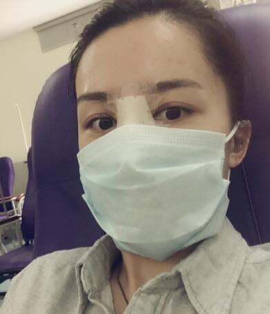 哈爾濱假體隆鼻價格8900元，隆鼻真實案例分享