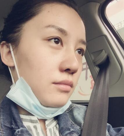 哈爾濱假體隆鼻價格8900元，隆鼻真實案例分享