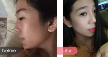 假體隆鼻術(shù)后注意事項(xiàng)和恢復(fù)過程圖分享