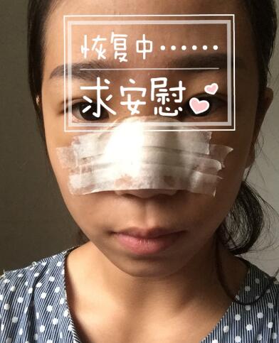 假體隆鼻術(shù)后注意事項(xiàng)和恢復(fù)過程圖分享