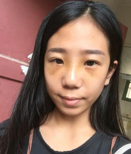 假體隆鼻術(shù)后注意事項(xiàng)和恢復(fù)過程圖分享