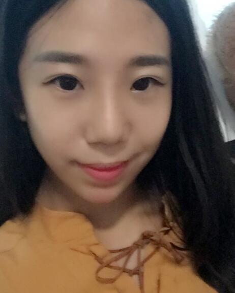 假體隆鼻術(shù)后注意事項(xiàng)和恢復(fù)過程圖分享