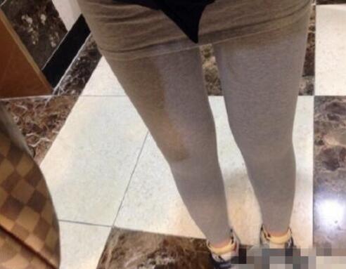 抽脂減肥瘦大腿價格10800元，一個月后恢復(fù)很好