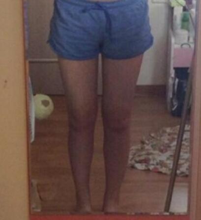 抽脂減肥瘦大腿價格10800元，一個月后恢復(fù)很好