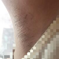 激光脫毛的價(jià)格380元，圖片分享