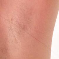 激光脫毛的價(jià)格380元，圖片分享