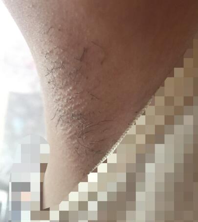 激光脫毛的價格380元，激光脫毛圖片分享