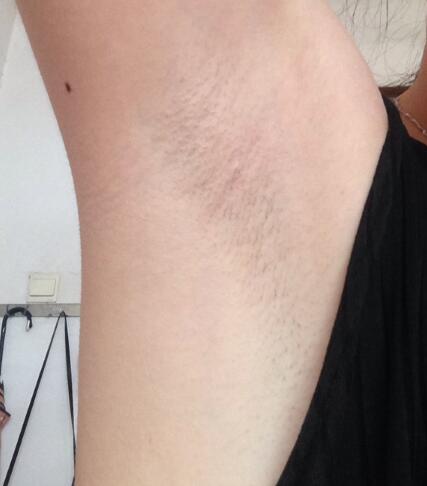 激光脫毛的價格380元，激光脫毛圖片分享