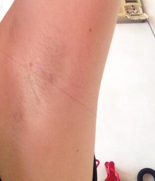 激光脫毛的價格380元，激光脫毛圖片分享