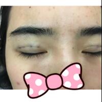 埋線雙眼皮恢復(fù)日志多對比圖分享